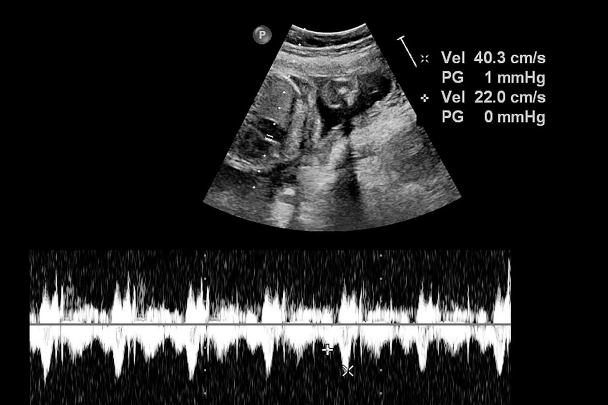 Fetal Ekokardiyografi Nedir